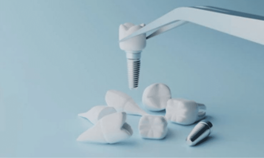 Dental Implant Restorations in Yuma