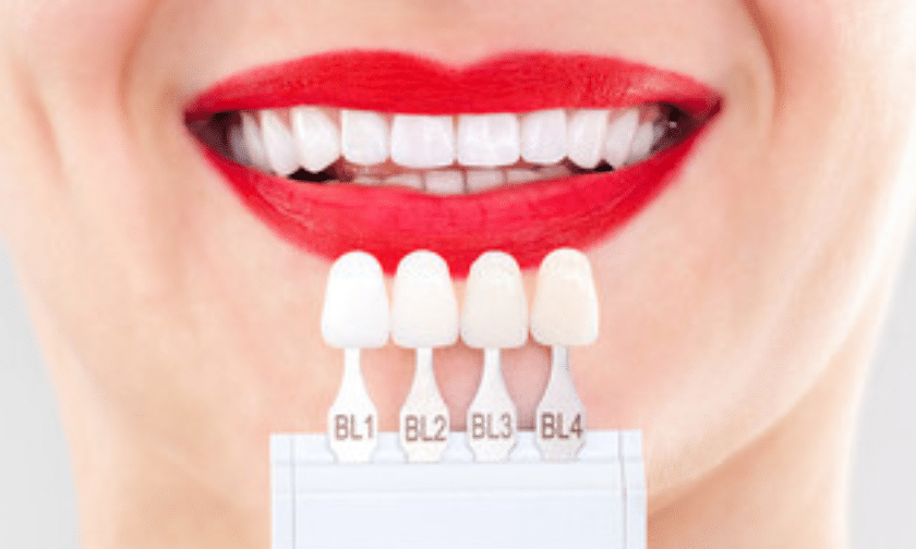 Myths about dental veneers