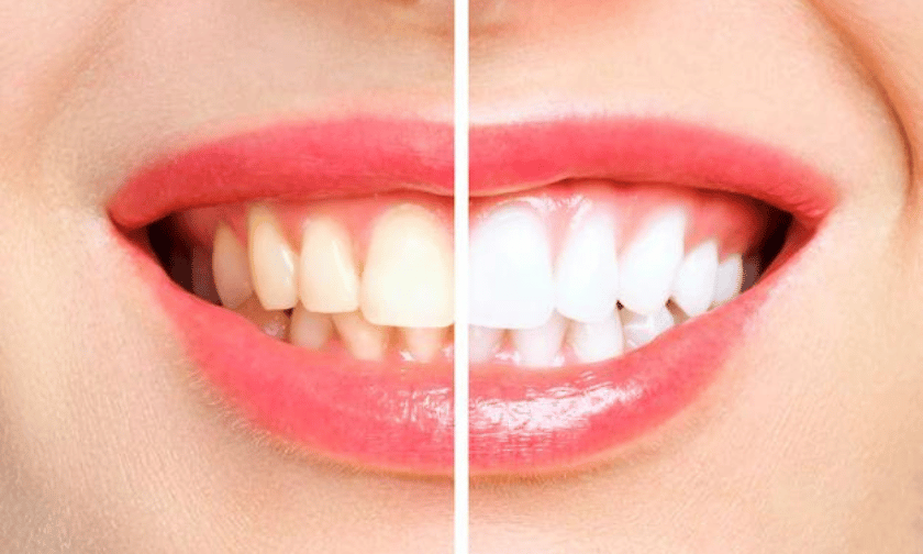 Safety Tips When Using Teeth Whitening Products at Home