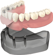 Implant Stabilized lp
