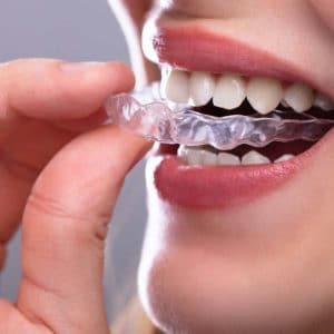 Person inserting clear orthodontic aligner tray into mouth for teeth straightening treatment.