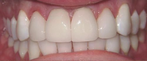 Close-up of a bright, healthy white smile showing upper and lower teeth aligned against pink gums.