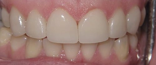 Close-up of dental veneers on upper front teeth showing bright white smile restoration.