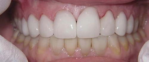 Close-up of white upper teeth and natural lower teeth showing dental alignment and smile aesthetics.