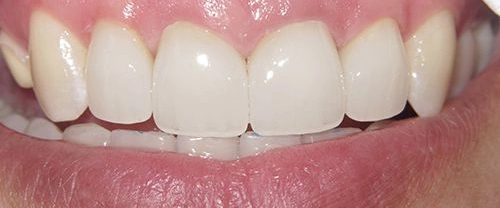 Close-up of healthy white teeth and smile showing dental care results.