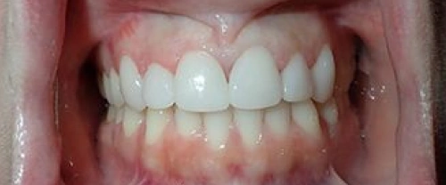 Close-up of healthy white teeth and gums in open mouth smile, dental care example.