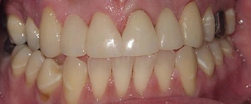 Close-up of natural-looking dental implants and crowns showing a complete smile restoration.