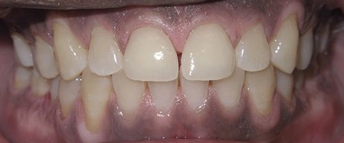Close-up of healthy upper and lower teeth showing proper dental alignment and white enamel.