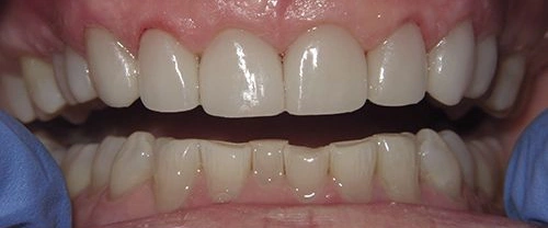 Close-up of natural-looking dental veneers or crowns displaying a bright, even smile with healthy gums.