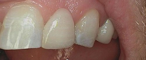 Close-up of four natural teeth showing dental work and tooth structure details.