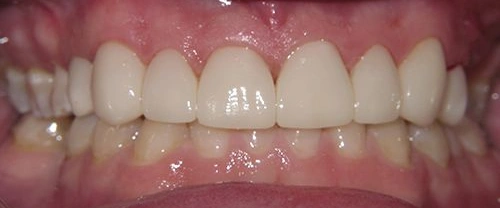 Close-up of healthy white teeth and pink gums showing dental health and smile aesthetics.
