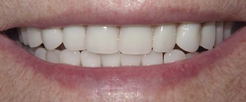 Close-up of a person's smile showing white teeth and lips against skin tone.