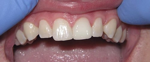 Close-up view of upper front teeth showing dental work and tooth alignment during examination.
