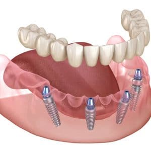 Dental implants in jawbone with artificial teeth crown restoration diagram