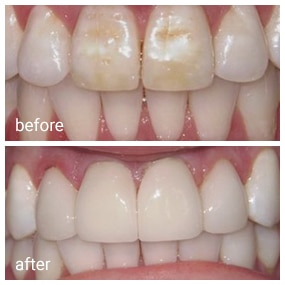 Before and after dental treatment showing tooth whitening and restoration results at Gila Ridge Dental.