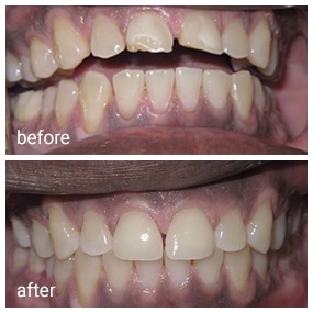 Before and after dental treatment comparison showing improved tooth alignment and whiteness.
