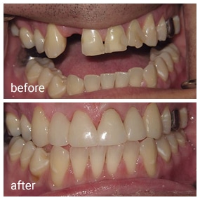 Before and after dental treatment showing improved teeth alignment and whitening at Gila Ridge Dental.