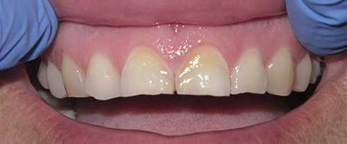 Close-up of upper front teeth showing dental work or cosmetic treatment in clinical setting.