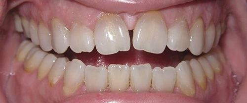 Close-up of teeth showing upper and lower dental alignment and bite during smile.