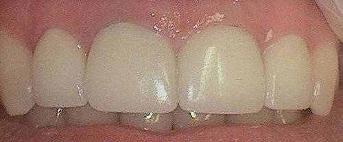 Close-up view of upper front teeth showing dental work or cosmetic dentistry results in clinical setting.