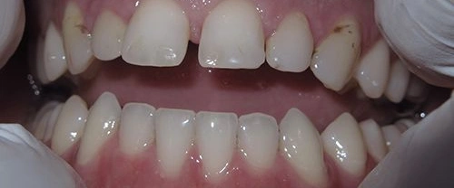 Close-up view of upper and lower teeth showing dental alignment and oral health condition.