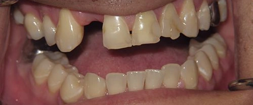 Close-up of teeth showing dental work, gaps, and tooth discoloration in mouth.