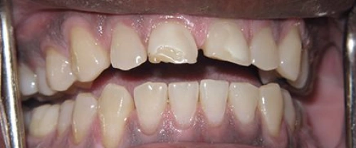 Close-up dental photograph showing upper and lower teeth in natural bite position, demonstrating dental alignment and oral health.