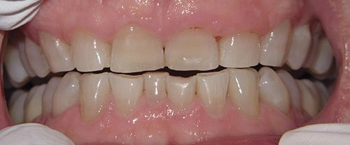 Close-up view of patient's teeth showing dental alignment and bite relationship during examination.