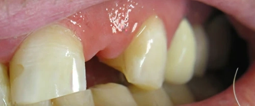 Close-up dental photograph showing natural tooth color and dental restoration work in mouth.