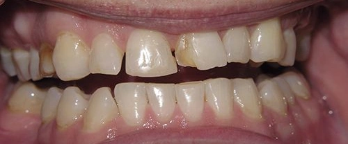 Close-up of patient's teeth showing dental work and bite alignment for examination.
