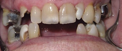 Close-up dental photograph showing upper and lower teeth with visible tooth decay and missing teeth.