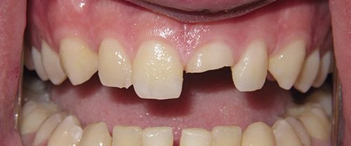 Close-up of upper front teeth showing a gap between central incisors and dental work.