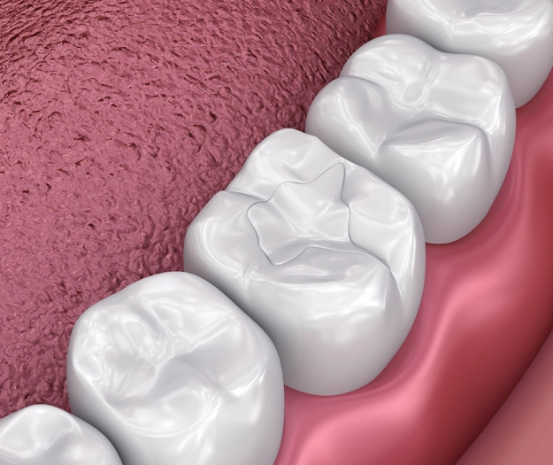 Three white dental crowns displayed on pink gum model showing tooth restoration options.