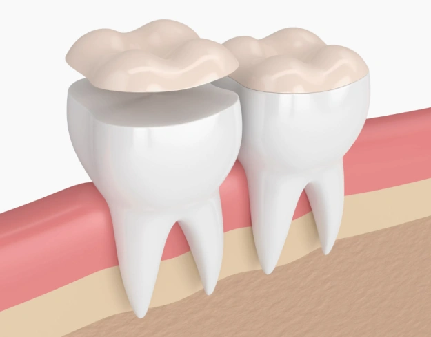Two teeth with dental crowns shown in cross-section of gum tissue and bone.