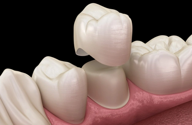 Dental crown placement demonstration showing tooth restoration on gum model with natural tooth shade matching.