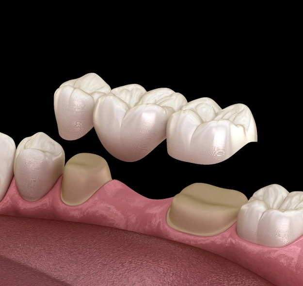 3D dental implant visualization showing crowns on gum model against black background.