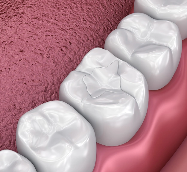 Three white dental crowns displayed on pink gum model surface for dental restoration demonstration.