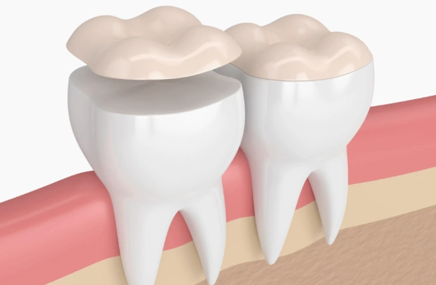 Two dental crowns placed on tooth models showing restorative dental treatment procedure.