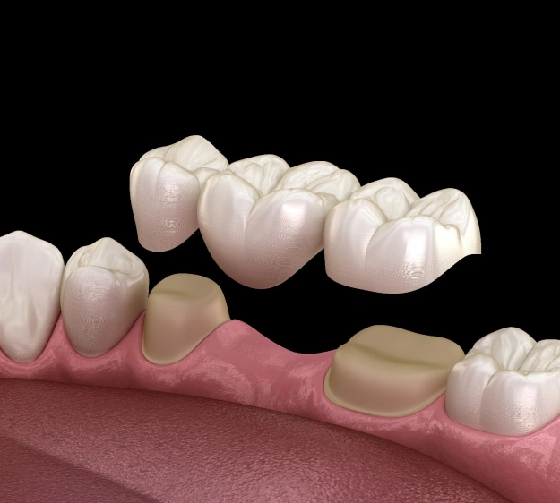 foothills dental bridges