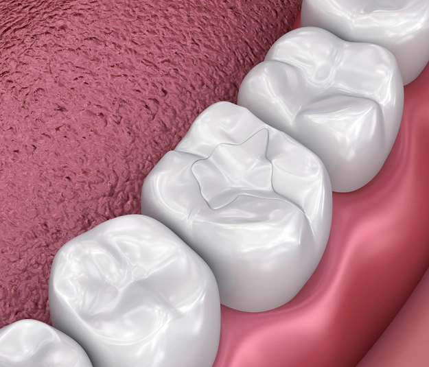 foothills dental fillings