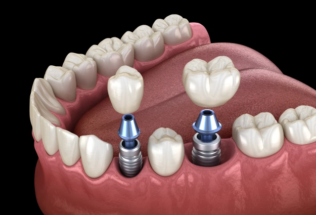 foothills dental implants