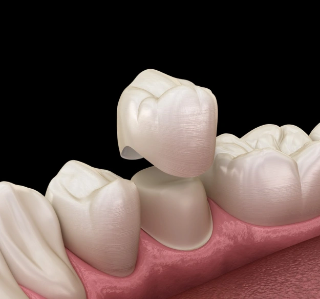 Dental crowns on model teeth showing restoration procedure with gum tissue detail