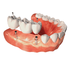 multi implant lp