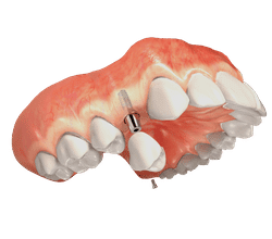 simgle implant lp