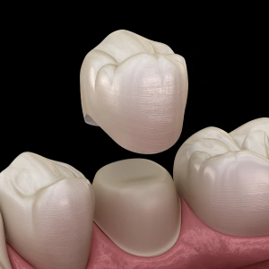 Dental crown restoration showing tooth-colored ceramic crown on implant with adjacent natural teeth and gum tissue model.