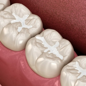 Three white dental crowns displayed on pink gum model showing occlusal surfaces and anatomy.
